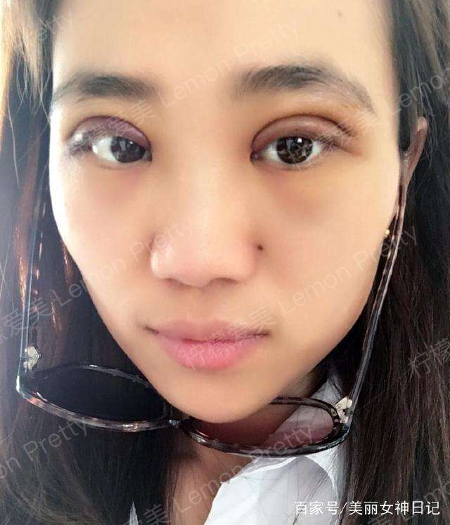 第4天嘞,还是肿肿的,打针吃药还这么慢,真心着急啊