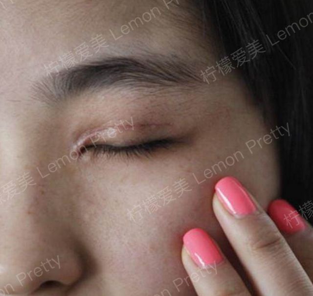 术后疤痕: 医生技术不到位或者是疤痕体质,就会让眼组织损坏严重,缝合