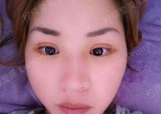 割双眼皮手术后恢复慢,迟迟不消肿,看看这8点注意事项