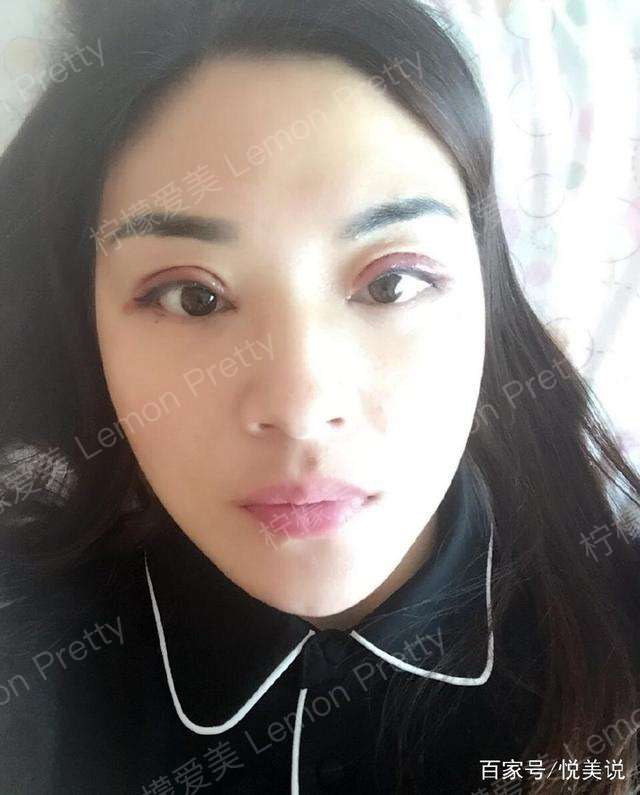 女店长做"全切双眼皮7mm"1个月后说:闺蜜夸她气质升级