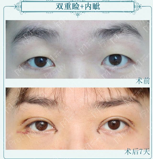 当眼球突出超过22mm,两眼差值大于2mm,或在观察中眼球突度不断增大,即