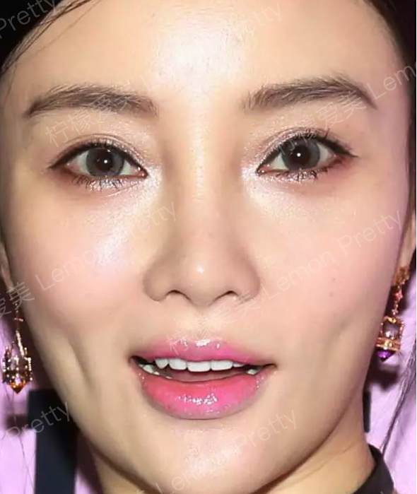 近年来,李小璐由于网红标配的"欧式大平行"宽双眼皮,一直被吐槽整容!