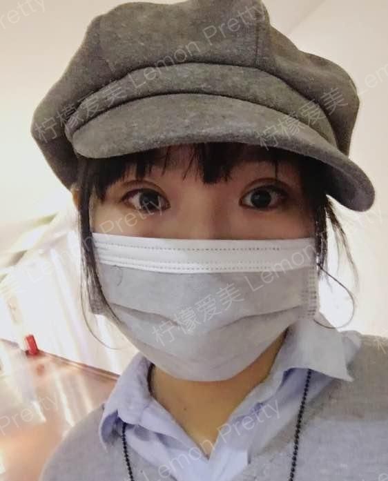 全切双眼皮5个月,各位仙女们觉得好看嘛