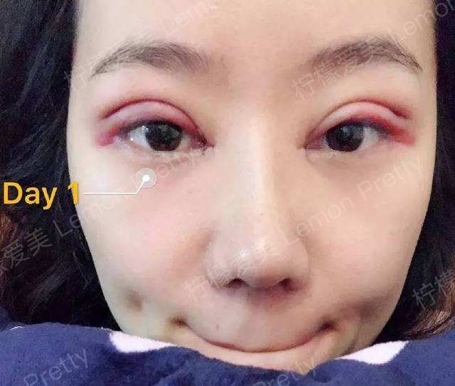 我做的是双眼皮全切 开眼角的手术,别问我开多宽,我真不知