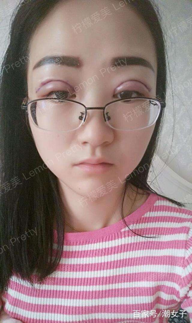 女实习生做过"双眼皮埋线 纹眉"后说:同事说我突然间成熟了!