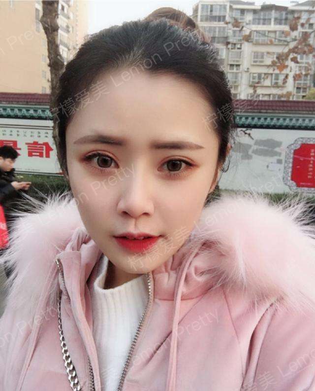 做了双眼皮4个月,感觉自己像仙女的造型,真的恢复的无敌好!