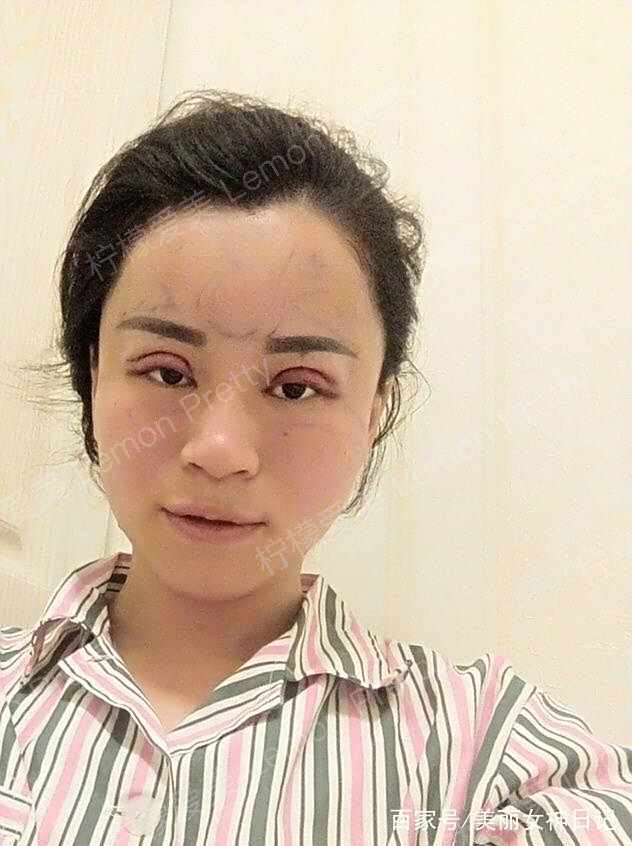 女销售做全切双眼皮 开眼角2个月后,变成"大小眼"了!该咋办?