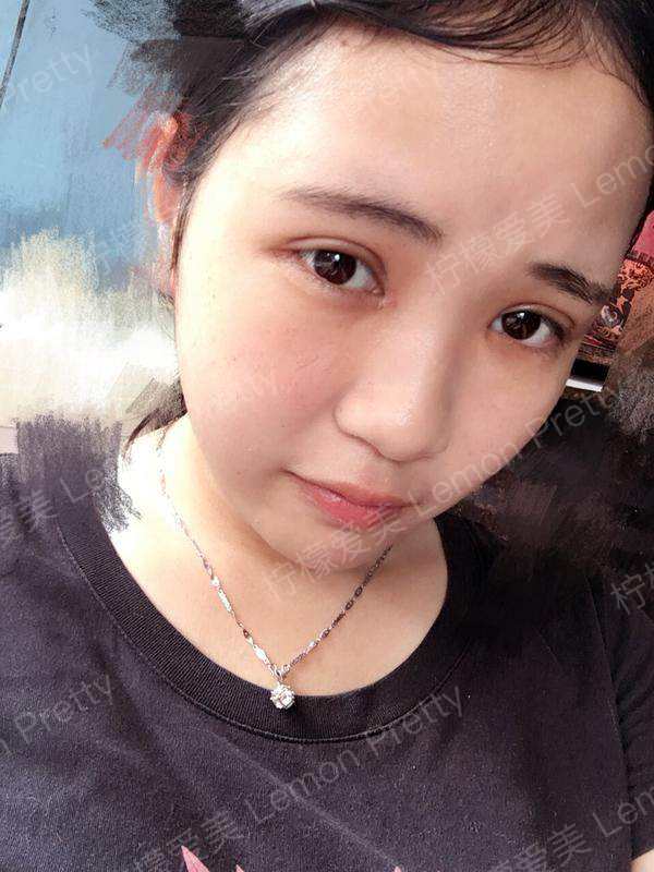 闺蜜做完"全切双眼皮7mm 开眼角"后,朋友们都劝我去做