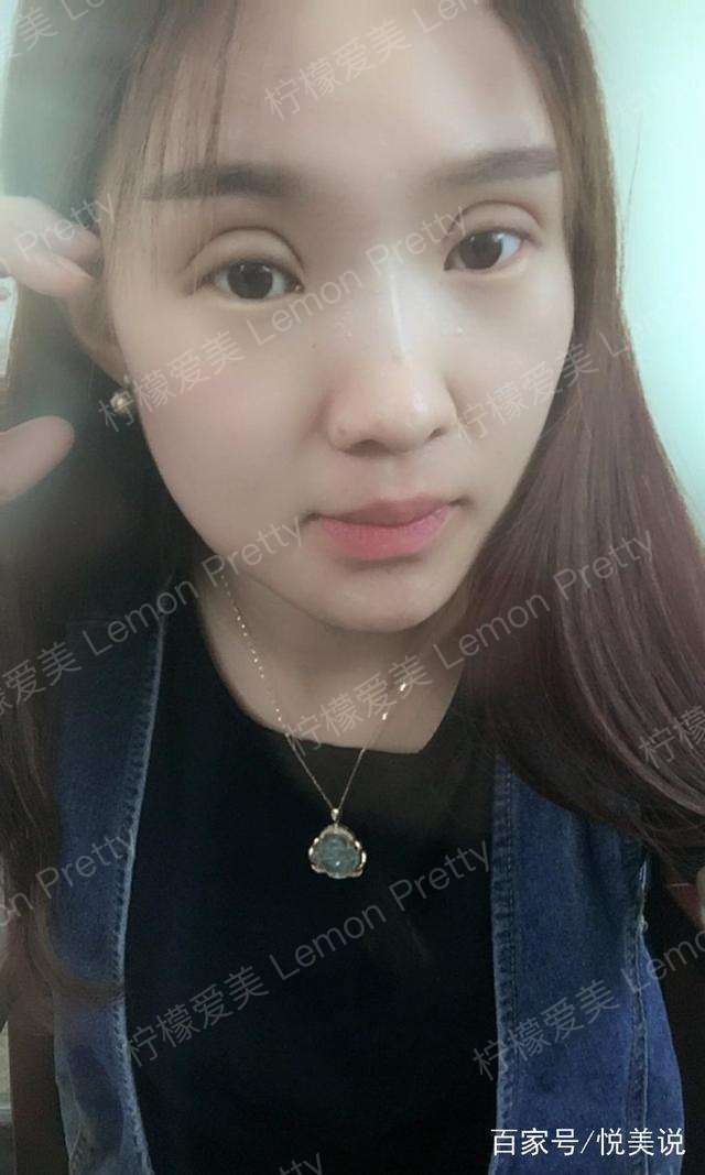 大三女生做"全切双眼皮8mm"2个月后说:都说我的双眼皮