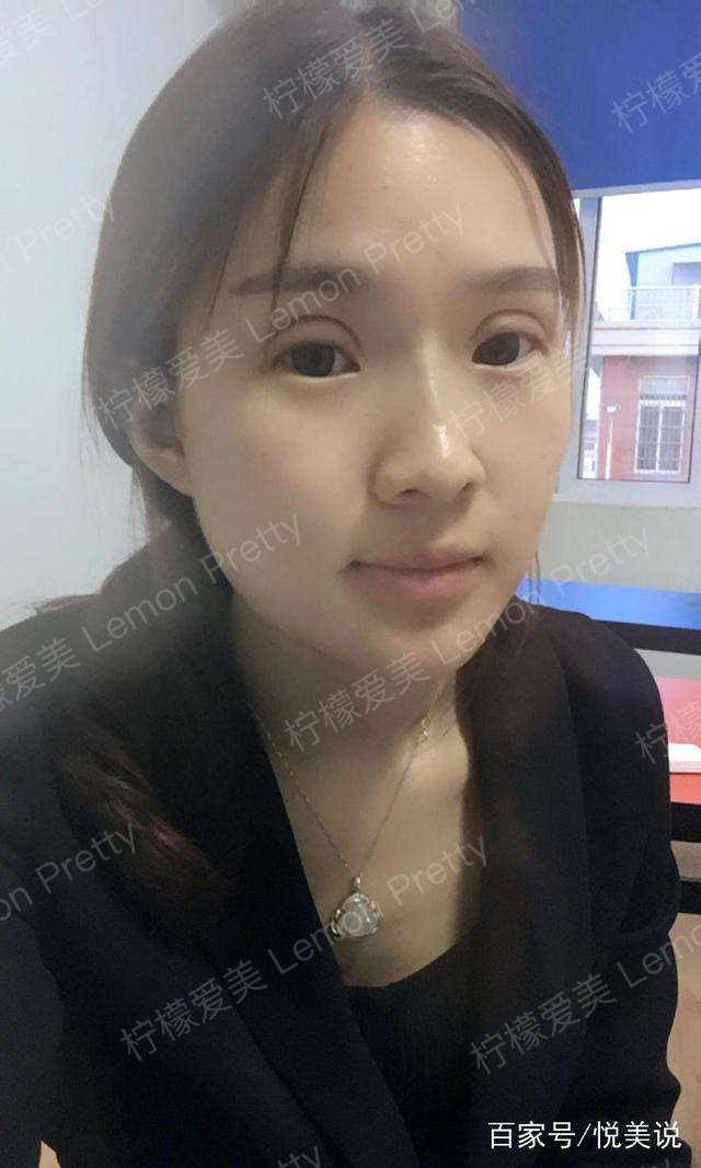 闺蜜见了说我:"你的双眼皮,完全割毁了,眼距那么窄,第一次看双眼皮割