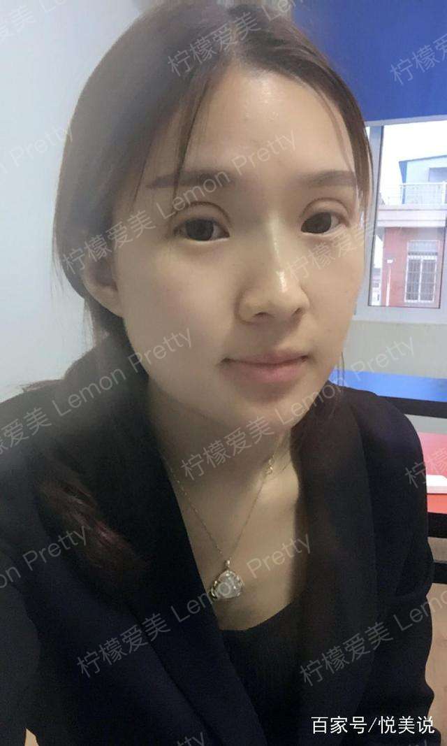 大三女生做"全切双眼皮8mm"2个月后说:都说我的双眼皮