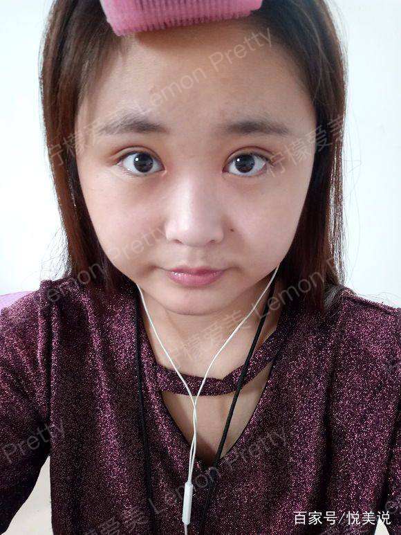 女学生做"全切双眼皮7mm 开眼角"后应验了一句俗话,要