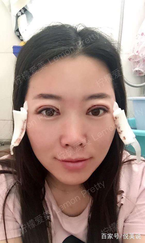 双眼皮7mm和8mm效果图,8mm开扇形双眼皮图片 辣妈做"全切双眼皮7mm 开眼角"2个月后说:化妆后才敢出门
