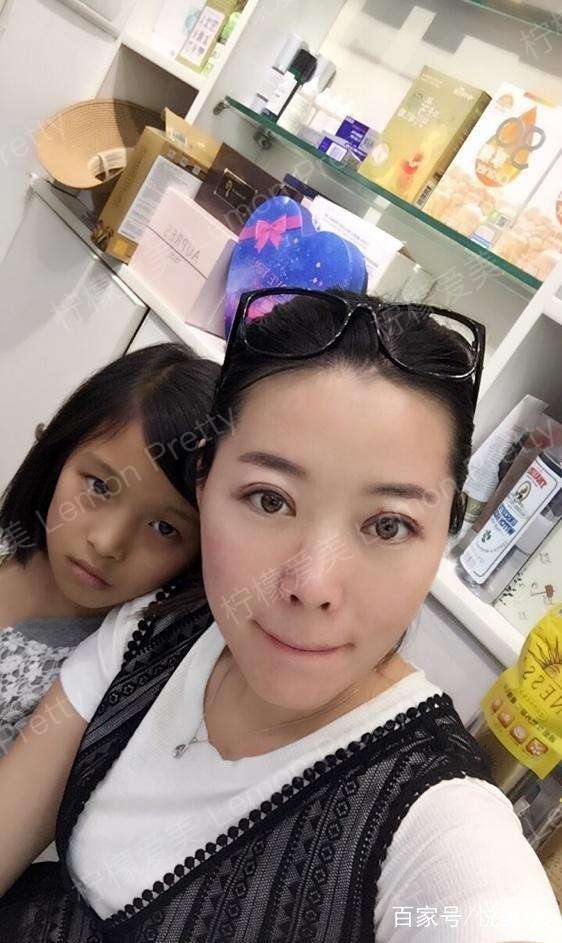 双眼皮7mm和8mm效果图,8mm开扇形双眼皮图片 辣妈做"全切双眼皮7mm 开眼角"2个月后说:化妆后才敢出门