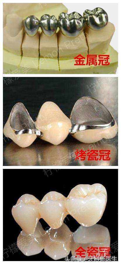 牙冠的材料首选全瓷冠,如果是后牙,个人对美观要求不高,可以考虑纯钛