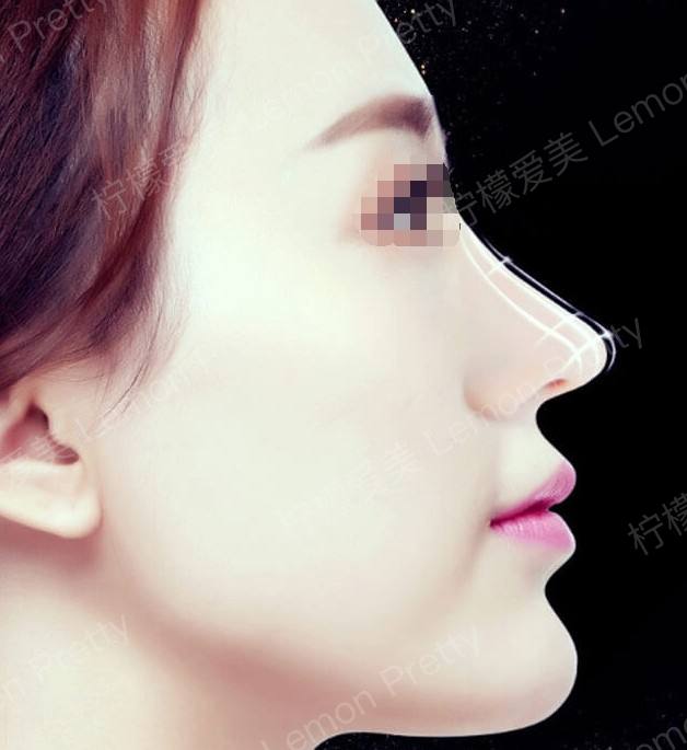 取自体肋软骨做隆鼻手术的话,对身体伤害大吗?