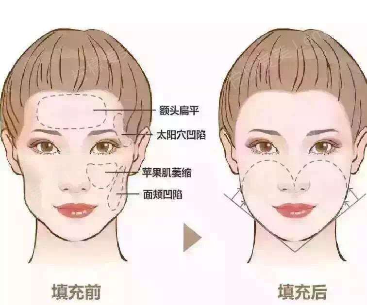 面部的颞部或上眼皮凹陷或者双颊深陷的人显得很老, 脸部轮廓过于平坦