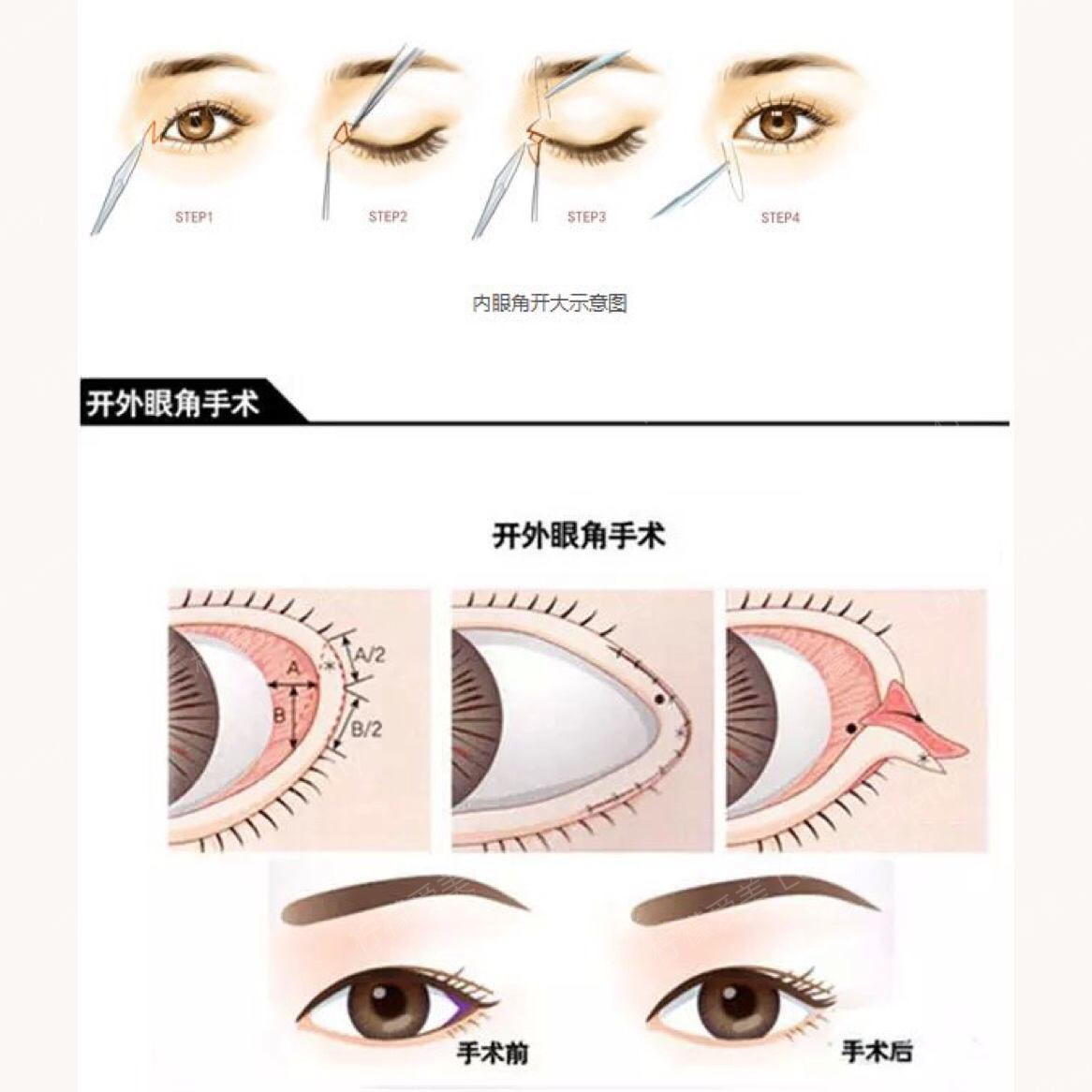 针对外眼角来说,如果切割4-5mm,恢复后大概只能看到2-3mm的效果哦.