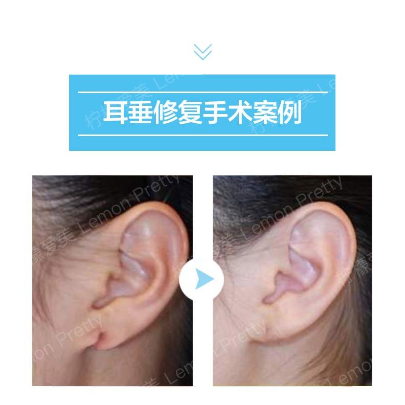 耳垂畸形的5大矫正方法_柠檬爱美_耳垂裂矫正,垂耳,丰