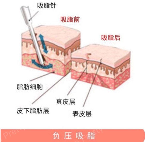 吸脂科普:水动力吸脂光纤溶脂对比应该怎么选?