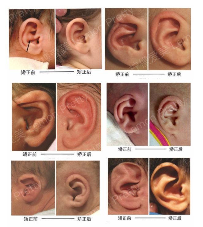 耳朵畸形矫正要趁早 宝宝出生一周后即可做矫正