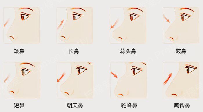 鼻子的整形分类,并不是所有人都适合小翘鼻!