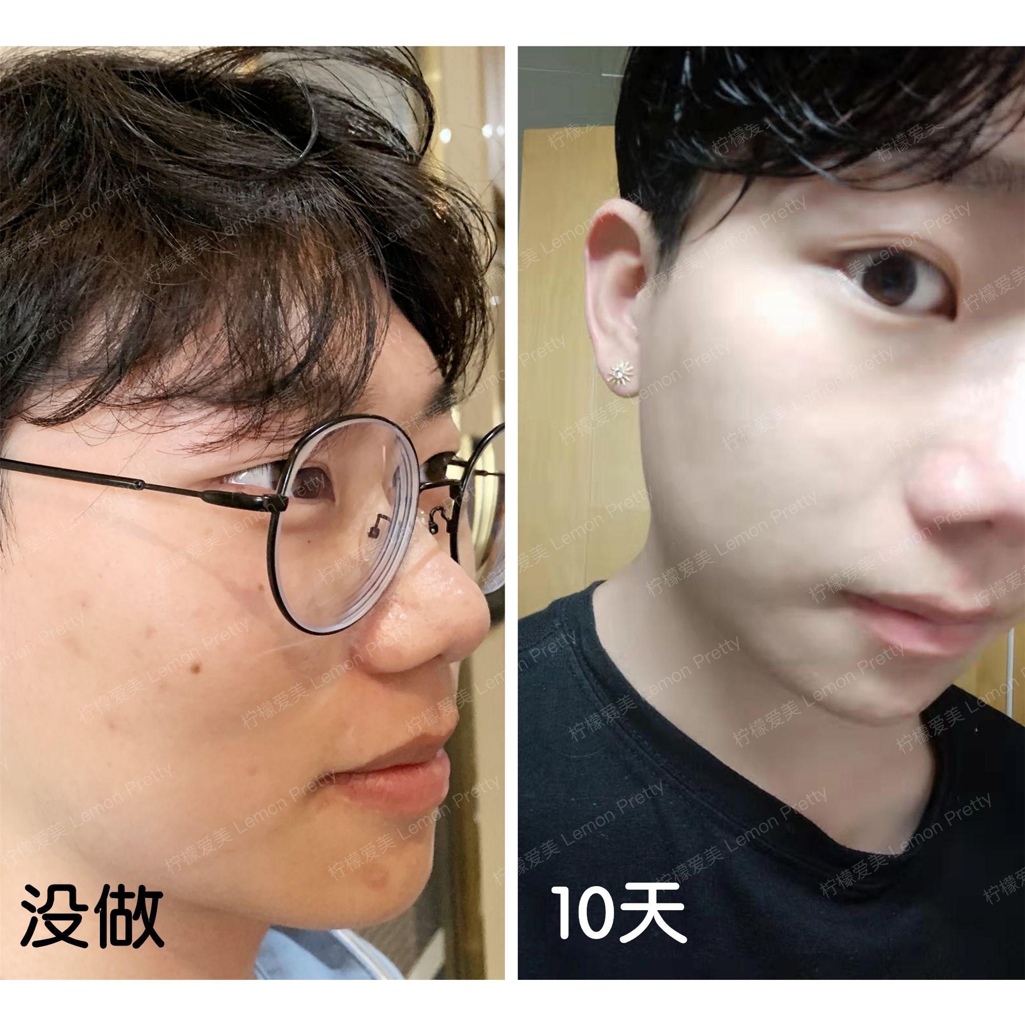男生也可以做医美/我的光子嫩肤医美体验