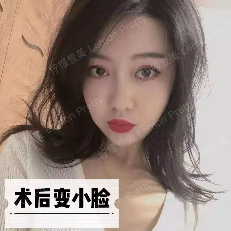 大饼脸秒变小v脸真的可能吗?