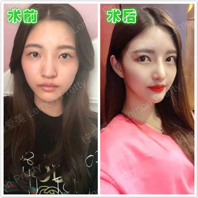 什么样的鼻子才算美鼻?有没有一个标准?