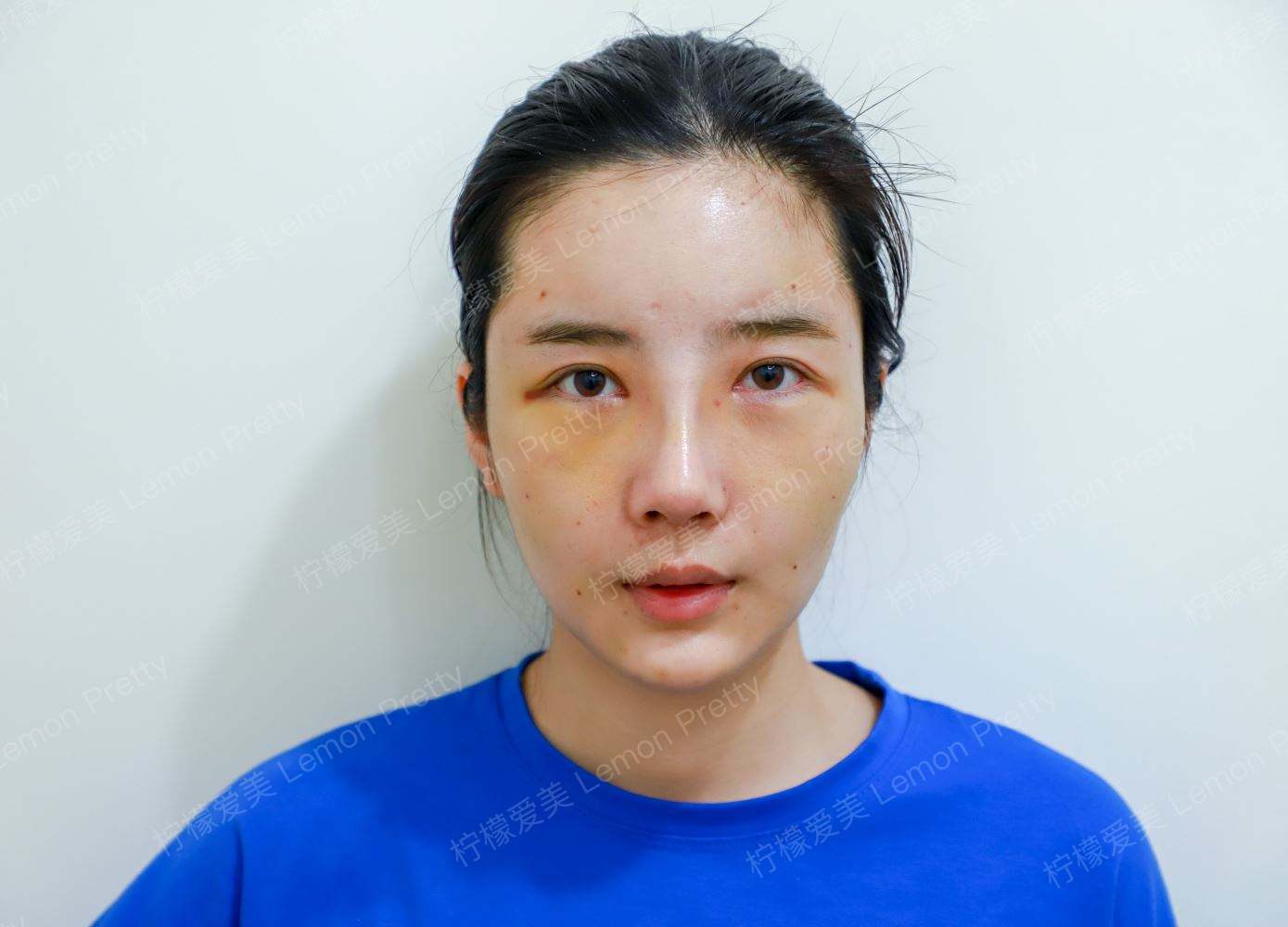 隆鼻后鼻子持续红肿是什么原因