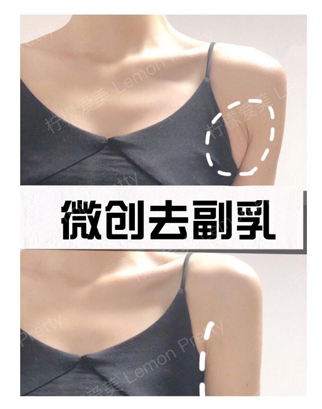 副乳是什么引起的?怎么去除?