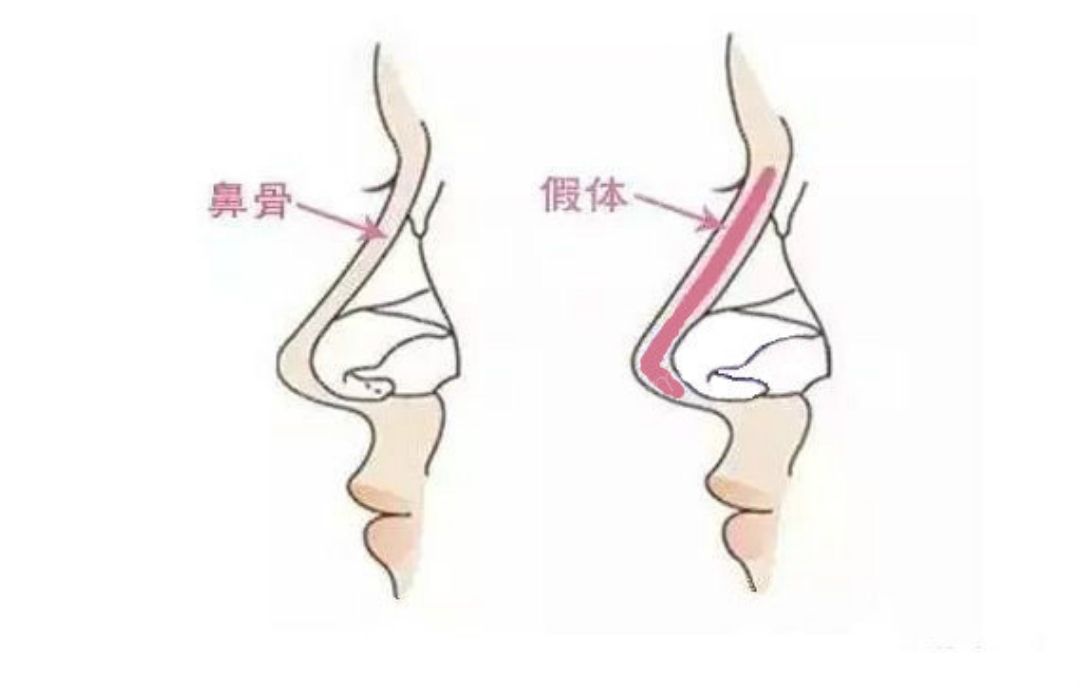 假体隆鼻优势有哪些?