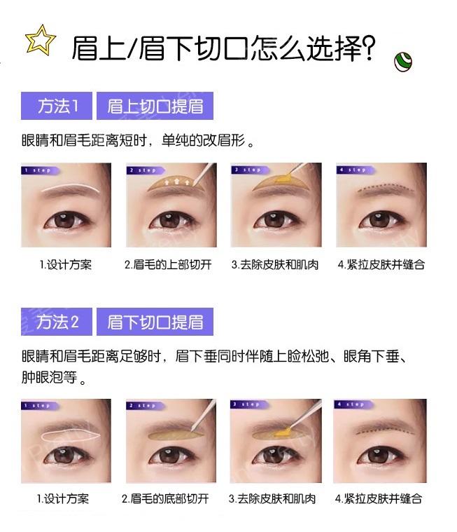 做提眉的切口位置,不是求美者说了算,同样也不是医生想怎样就怎样的