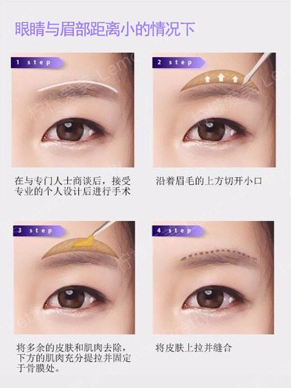 提眉vs切眉?傻傻分不清楚?