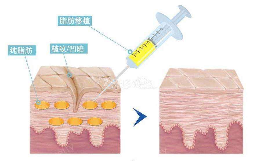 vegf血管内皮生长因子:强力修复组织,产生胶原蛋白,激生透明质酸.