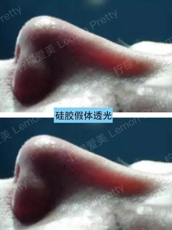 还有一种情况,医生雕刻的假体过大过厚,当大而厚的假体植入鼻部后,会