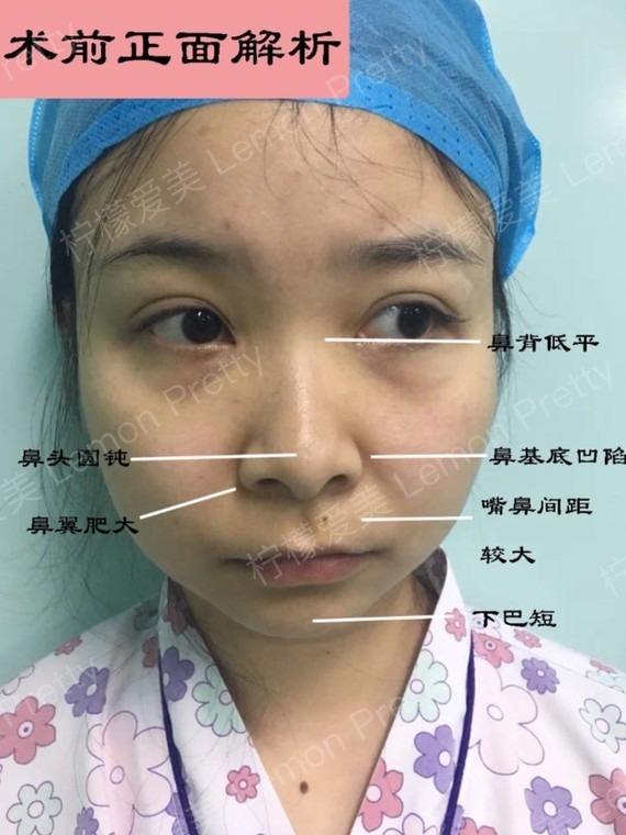 发布于 2020-04-23 问题咨询 鼻翼张角处的主要问题是鼻翼两侧肥厚