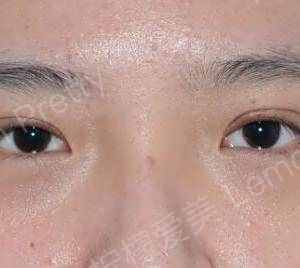 重睑术〕小眼睛是每个女生最大的痛了吧,好像一直没睡醒一样,而且我