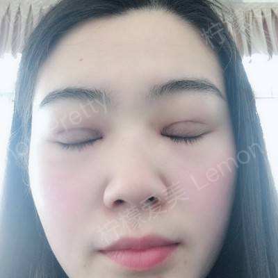 埋线双眼皮〕昨天去医院把线拆了,心里真的超级激动,因为可以看到