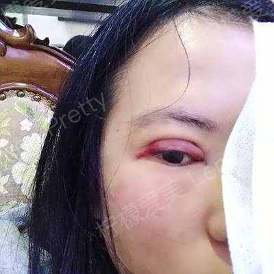 埋线双眼皮〕第二天去拆了纱布,下面是左眼右眼照,第二天第三天是最