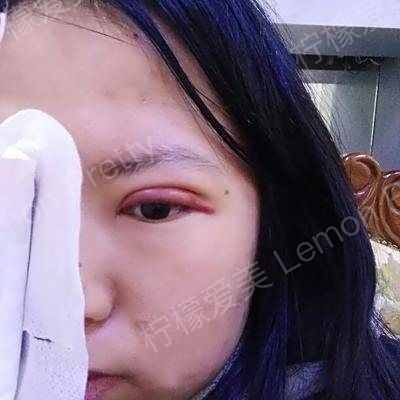 埋线双眼皮〕第二天去拆了纱布,下面是左眼右眼照,第二天第三天是最