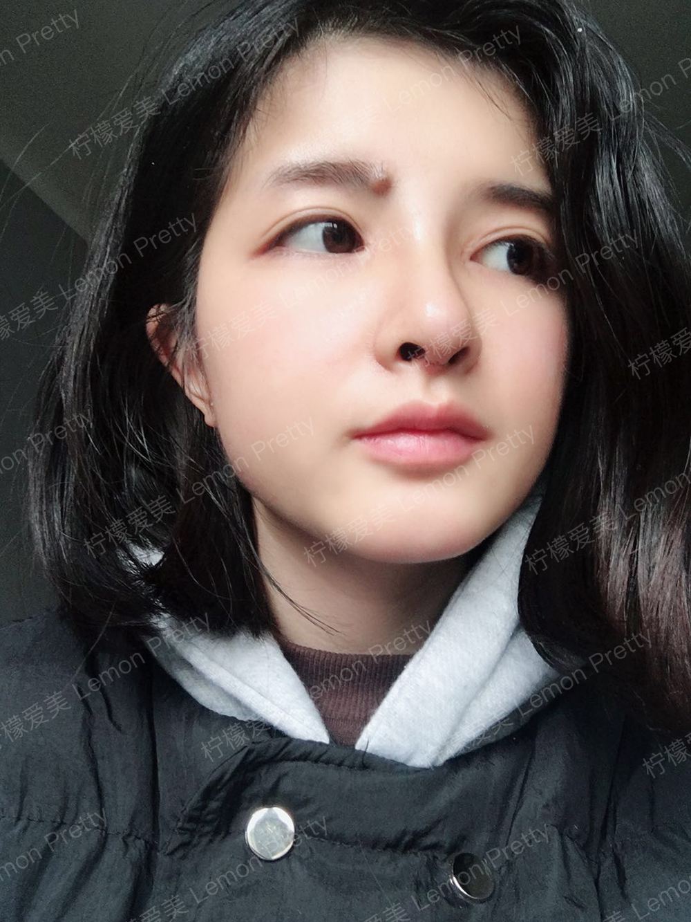 硅胶隆鼻