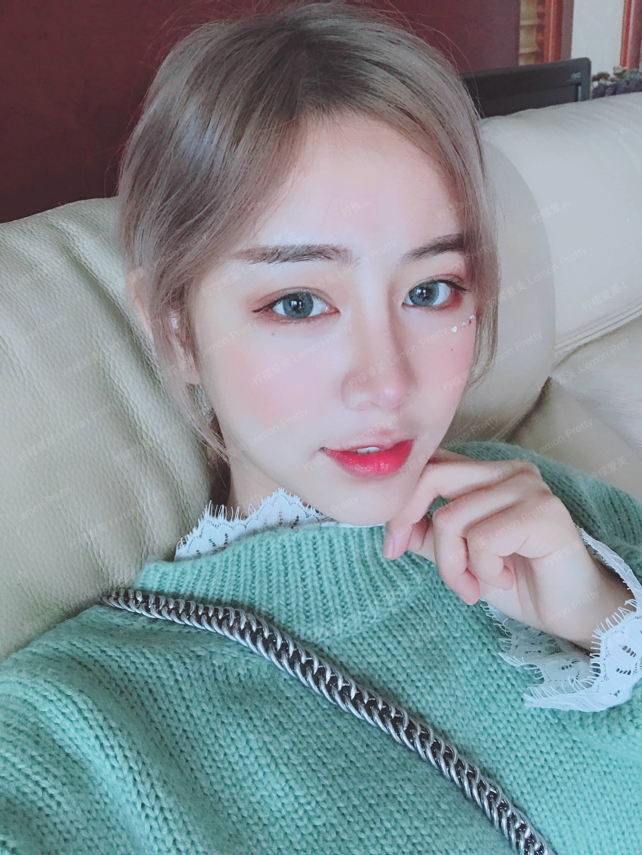 檬檬7167肋软骨隆鼻的美丽日记-柠檬爱美app