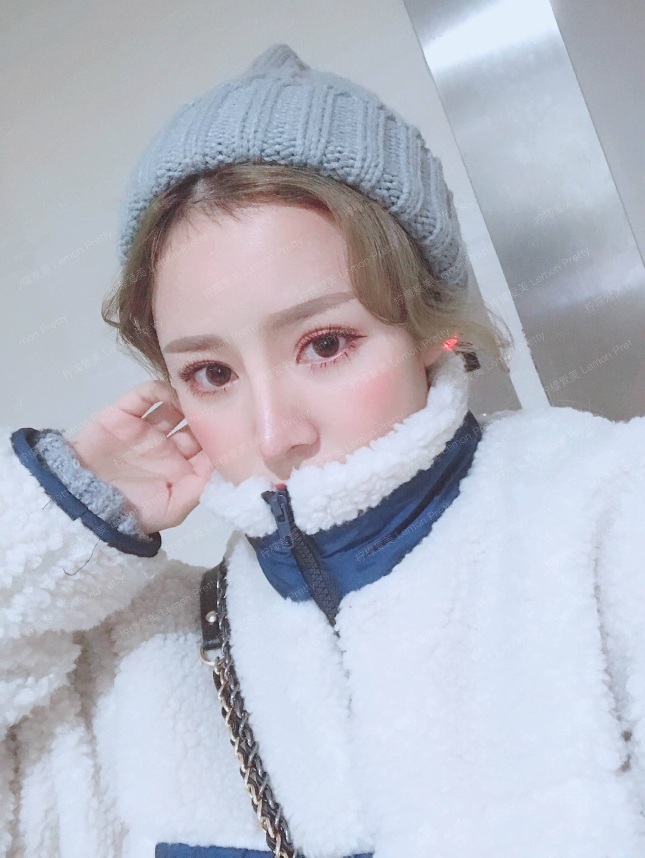 檬檬7167肋软骨隆鼻的美丽日记-柠檬爱美app