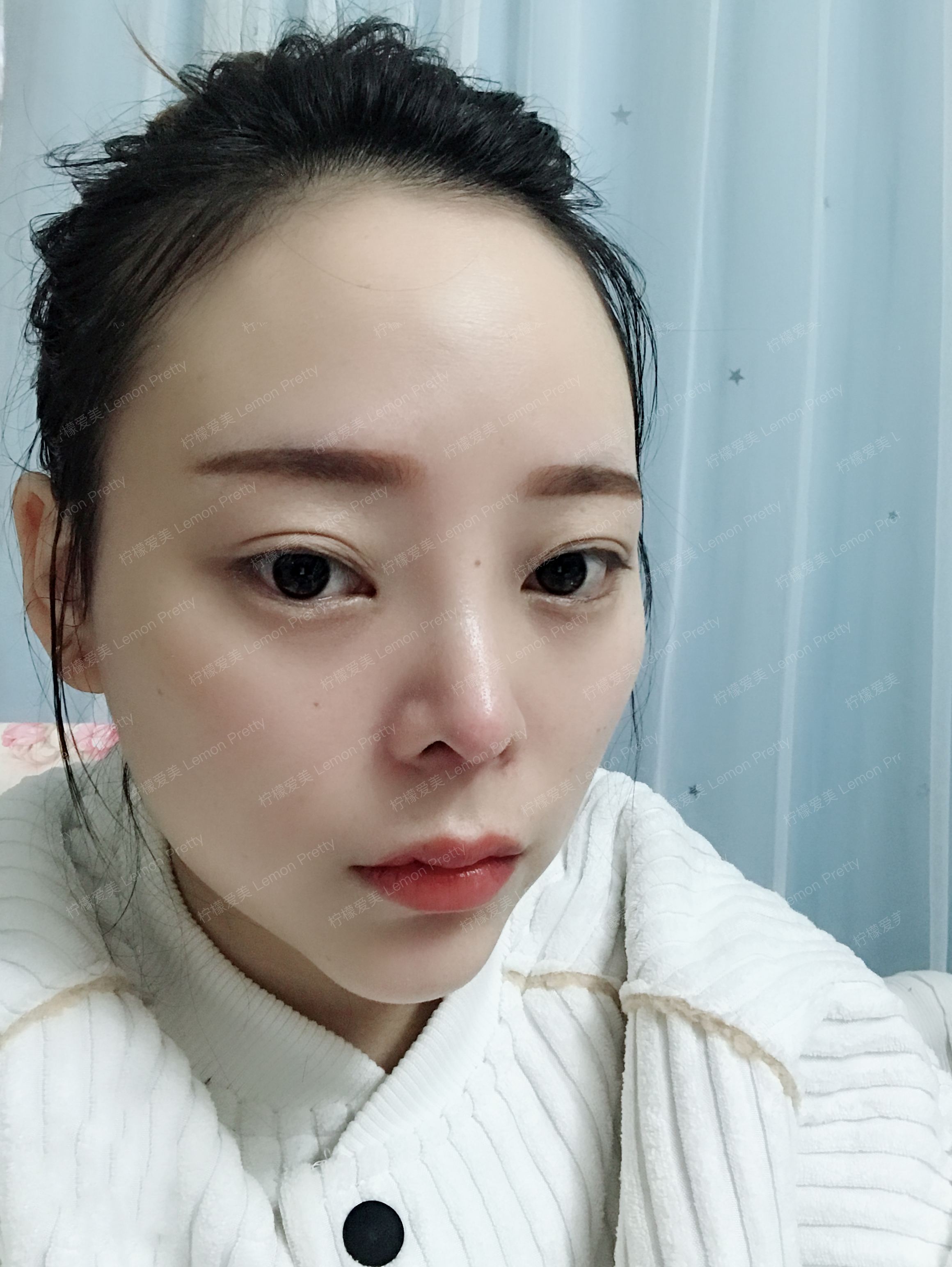 术后第15天 亲们,我来更新了,来反馈效果了哈