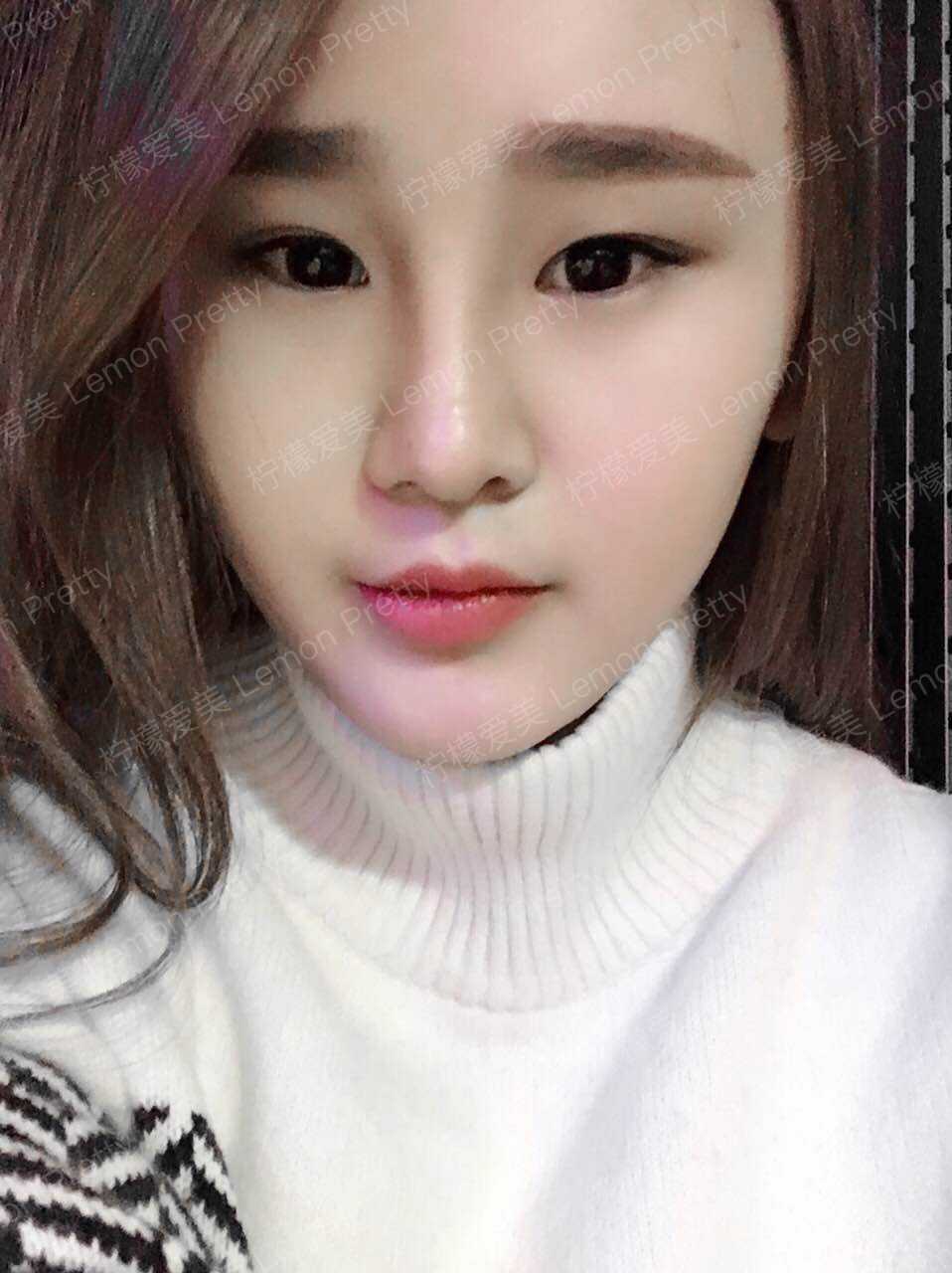 耳软骨复合隆鼻