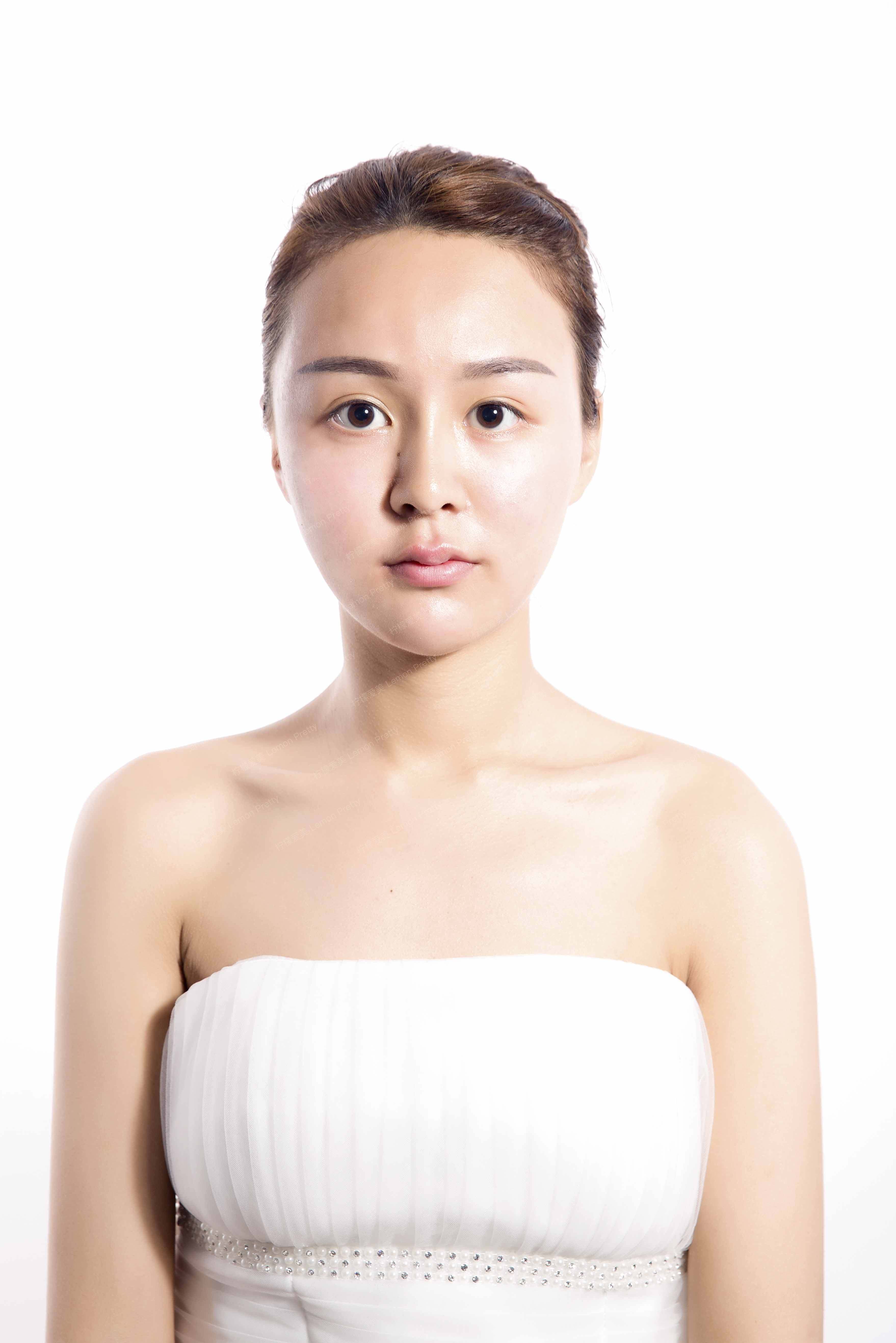 玻尿酸全脸填充