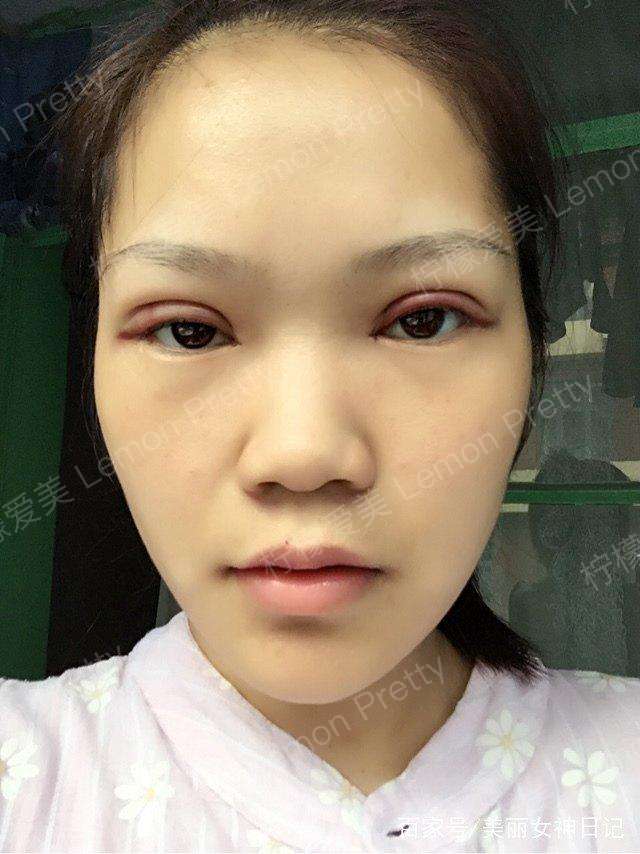 做双眼皮和开眼角后,小姐姐的鼻子更塌了,现在考虑垫鼻子呢!