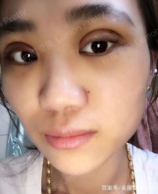 宝妈做全切双眼皮2个月了,画眼线,涂口红后,都说她很妖艳!