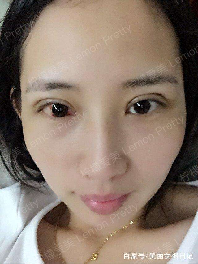 学妹做全切双眼皮 开眼角1个月后问:平行扇形双眼皮是这样的吗?